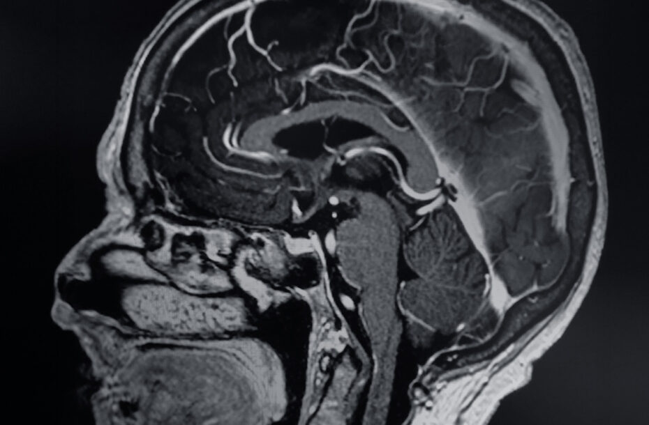 Aivoaneurysma – kuinka yleinen se on ja miten se voidaan havaita?
