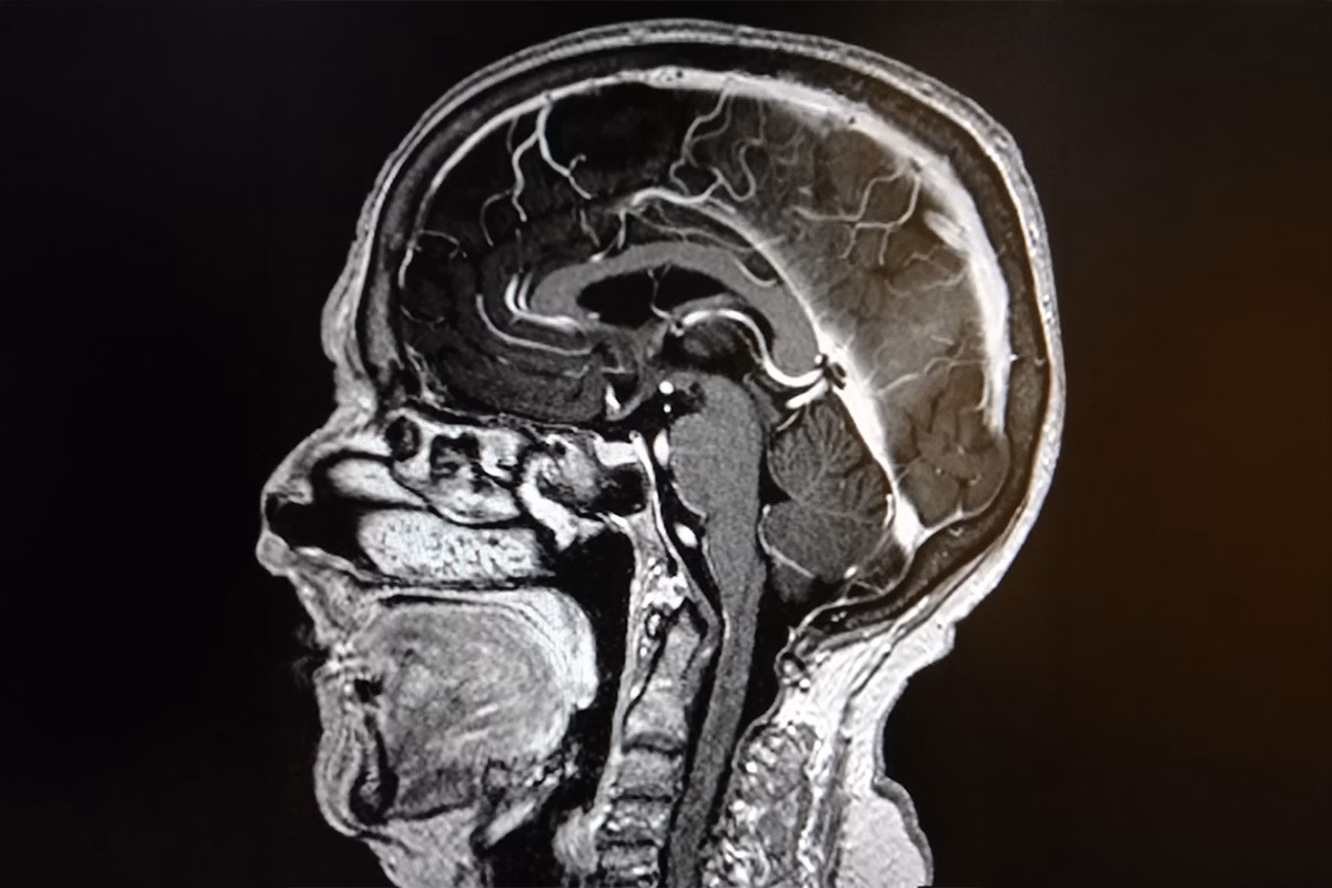 Exploding Head Syndrome: Was steckt hinter diesem beängstigenden, aber harmlosen Schlafphänomen?